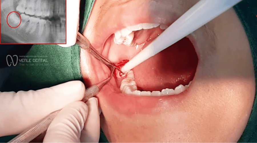 nhổ răng khôn có ảnh hưởng gì không